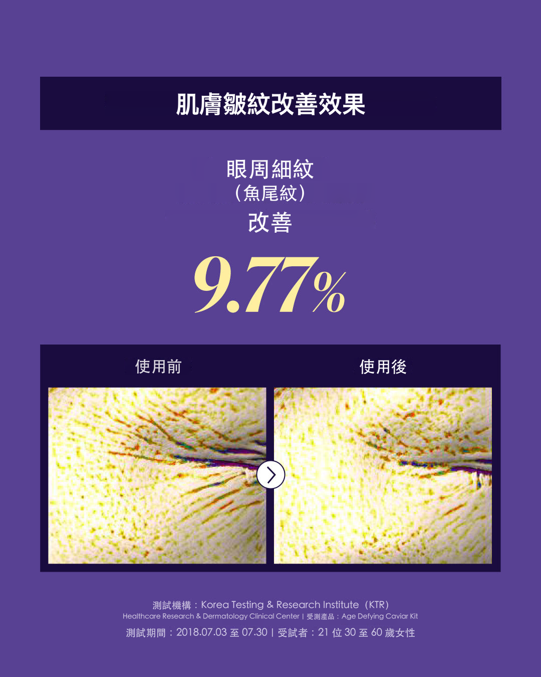 肌膚皺紋改善效果：眼周細紋（魚尾紋）改善 9.77%，使用前後對比；受測產品 Age Defying Caviar Kit