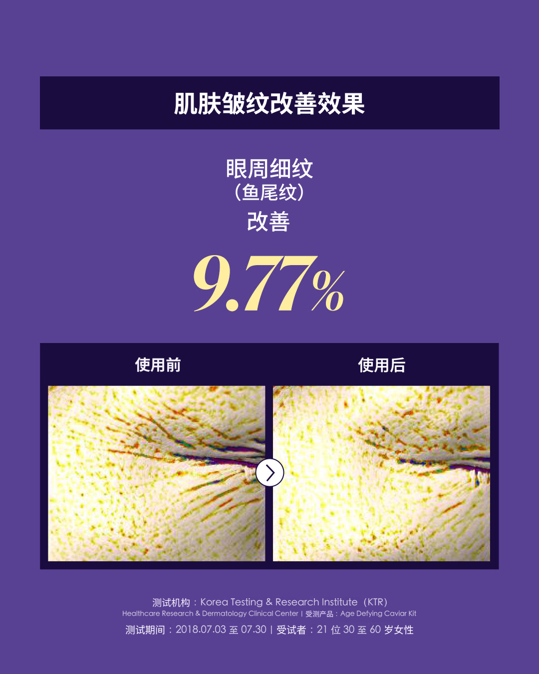肌肤皱纹改善效果：眼周细纹（鱼尾纹）改善 9.77%，使用前后对比；受测产品 Age Defying Caviar Kit